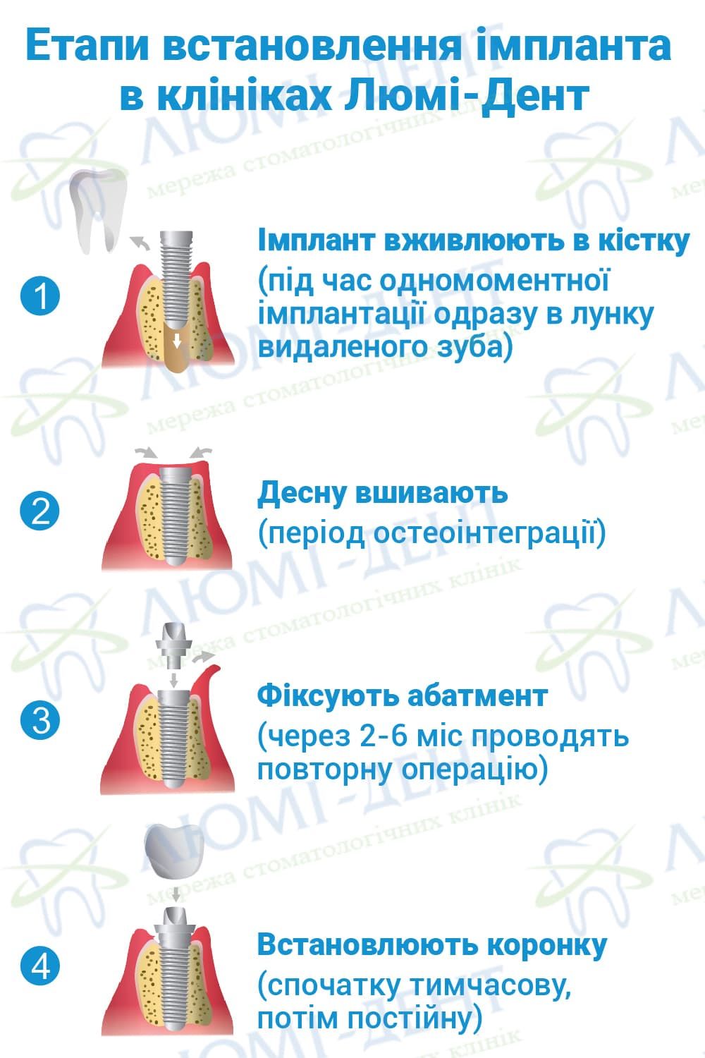 Етапи встановлення імпланта